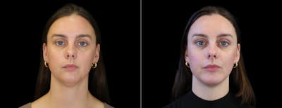 Neck Liposuction Before & After Gallery - Patient 320831 - Image 1