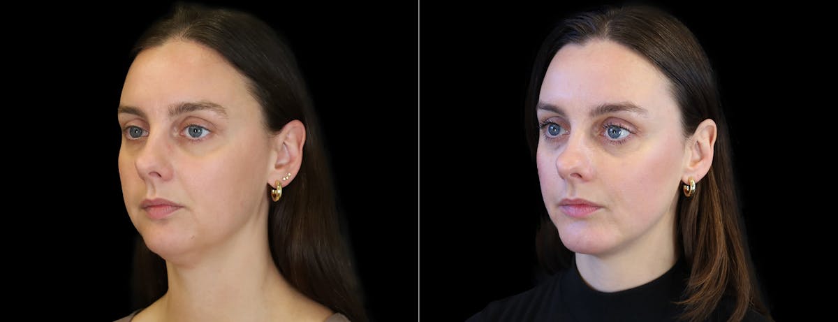 Chin Augmentation Before & After Gallery - Patient 147726 - Image 3