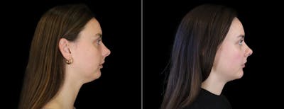 Chin Augmentation Before & After Gallery - Patient 147726 - Image 1