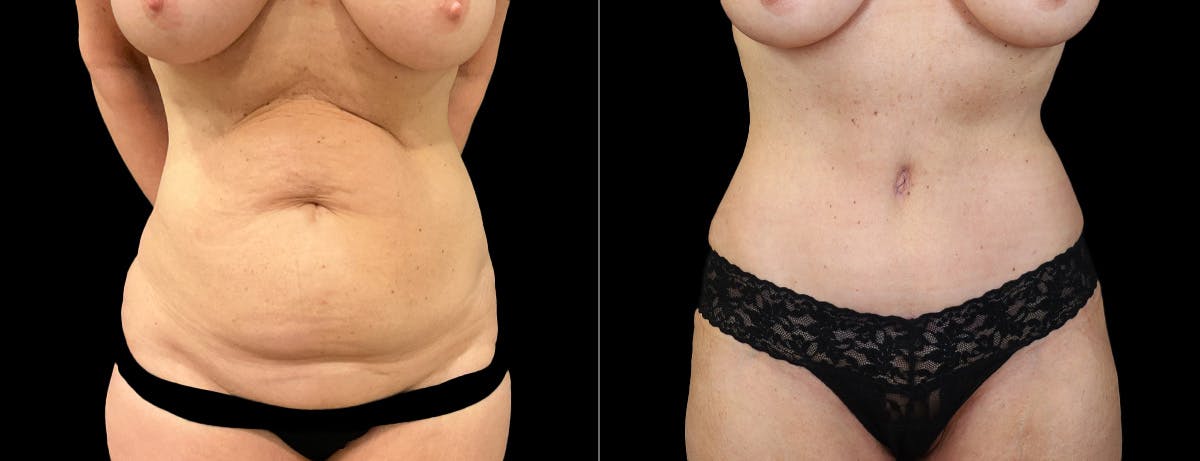 Abdominoplasty (Tummy Tuck) Before & After Gallery - Patient 332059 - Image 1