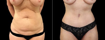 Abdominoplasty (Tummy Tuck) Before & After Gallery - Patient 332059 - Image 1