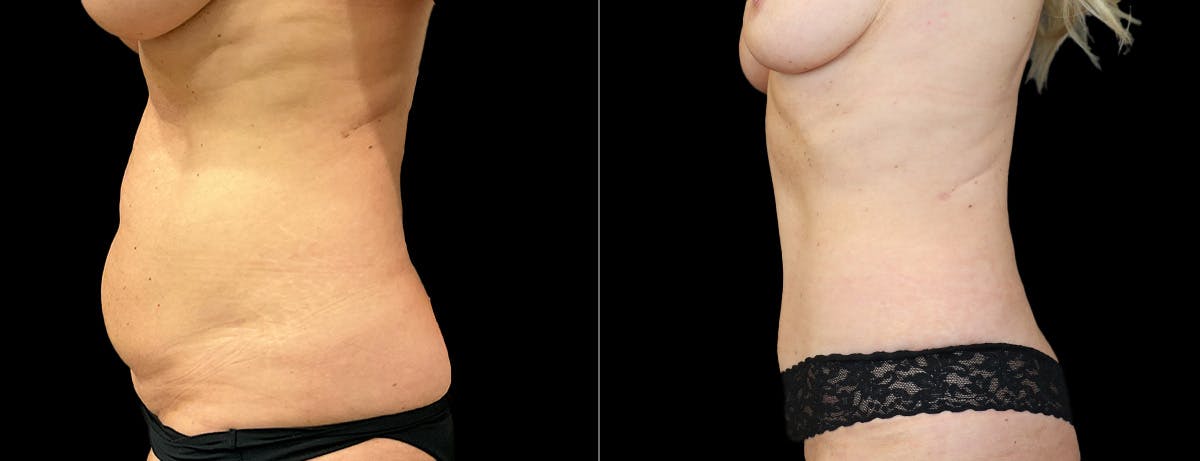 Abdominoplasty (Tummy Tuck) Before & After Gallery - Patient 332059 - Image 2