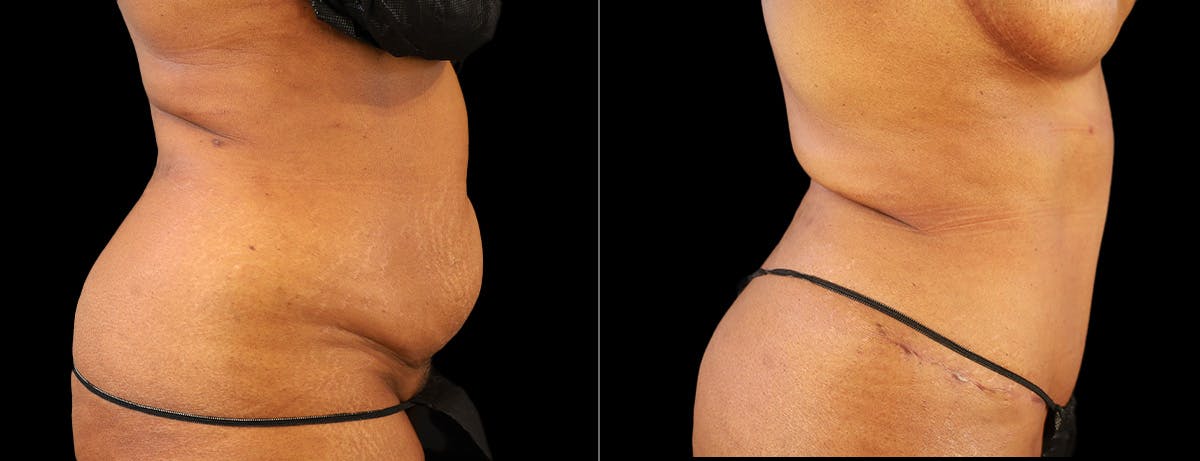 Abdominoplasty (Tummy Tuck) Before & After Gallery - Patient 277693 - Image 2