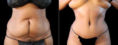 Abdominoplasty (Tummy Tuck) Before & After Gallery - Patient 277693 - Image 1