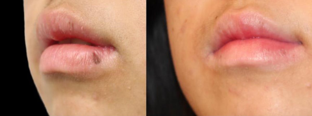 Pico Laser Before & After Gallery - Patient 142972 - Image 1
