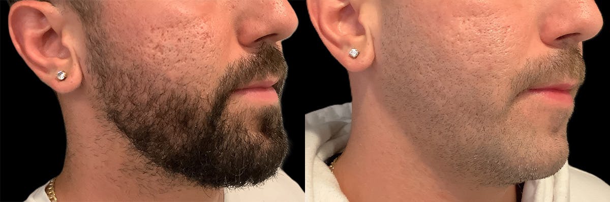 CO2 Laser Resurfacing Before & After Gallery - Patient 417144 - Image 1