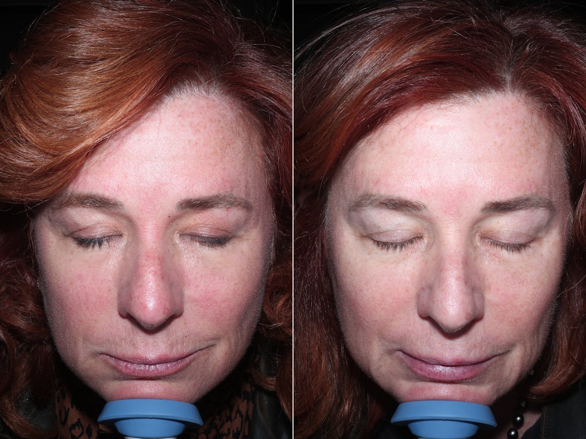 Excel V Before & After Gallery - Patient 228442 - Image 1
