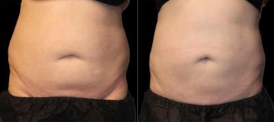 Coolsculpting Before & After Gallery - Patient 408121 - Image 1