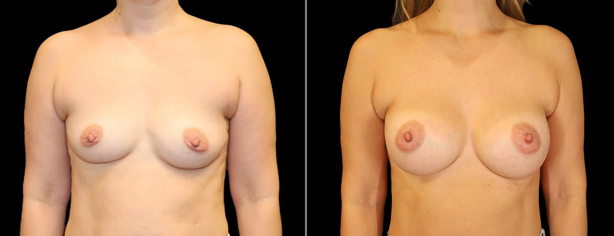 Breast Augmentation Before & After Gallery - Patient 384620 - Image 1