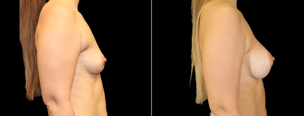 Breast Augmentation Before & After Gallery - Patient 384620 - Image 3