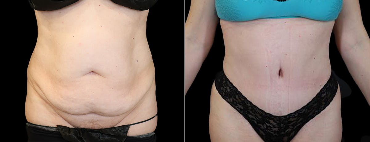 Abdominoplasty (Tummy Tuck) Before & After Gallery - Patient 225387 - Image 1