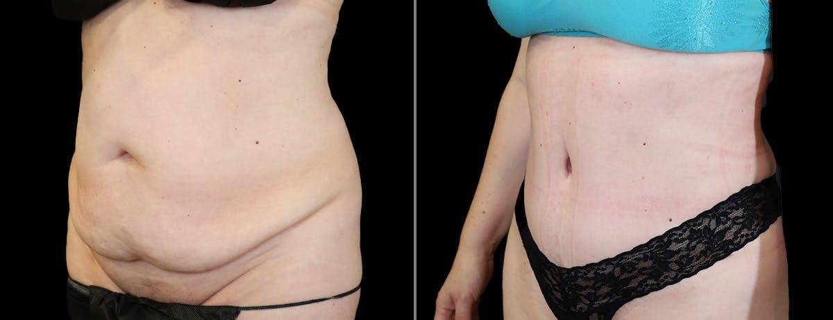 Abdominoplasty (Tummy Tuck) Before & After Gallery - Patient 225387 - Image 2