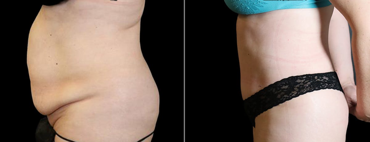 Abdominoplasty (Tummy Tuck) Before & After Gallery - Patient 225387 - Image 3