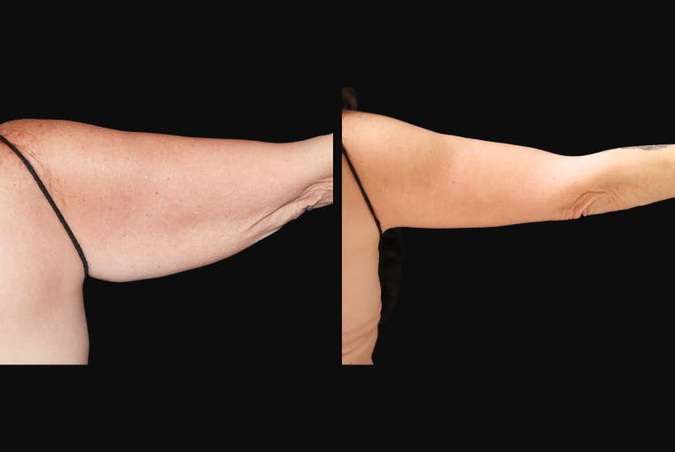 Arm Lift (Brachioplasty) Before & After Gallery - Patient 165663 - Image 2