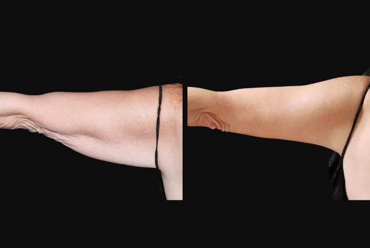 Arm Lift (Brachioplasty) Before & After Gallery - Patient 165663 - Image 1