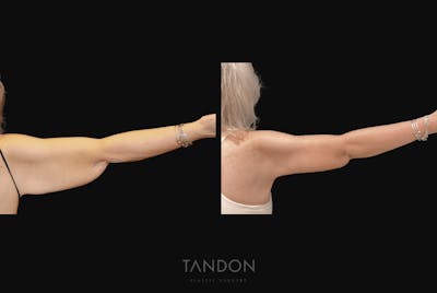 Arm Lift (Brachioplasty) Before & After Gallery - Patient 414394 - Image 1
