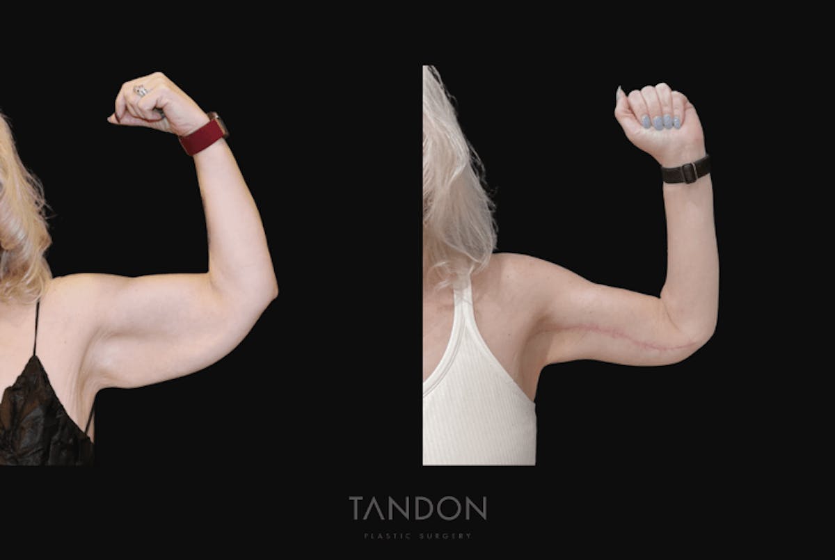 Arm Lift (Brachioplasty) Before & After Gallery - Patient 414394 - Image 2