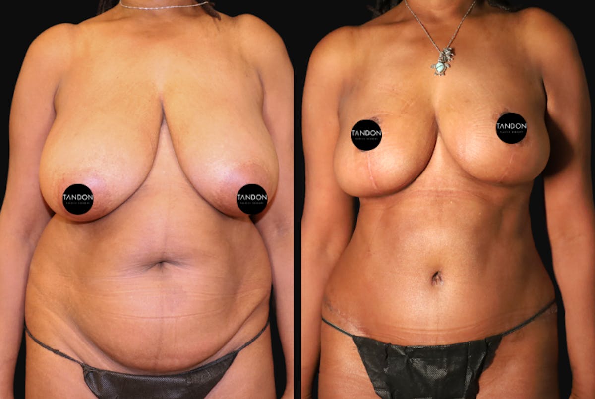 Mommy Makeover Before & After Gallery - Patient 458709 - Image 1
