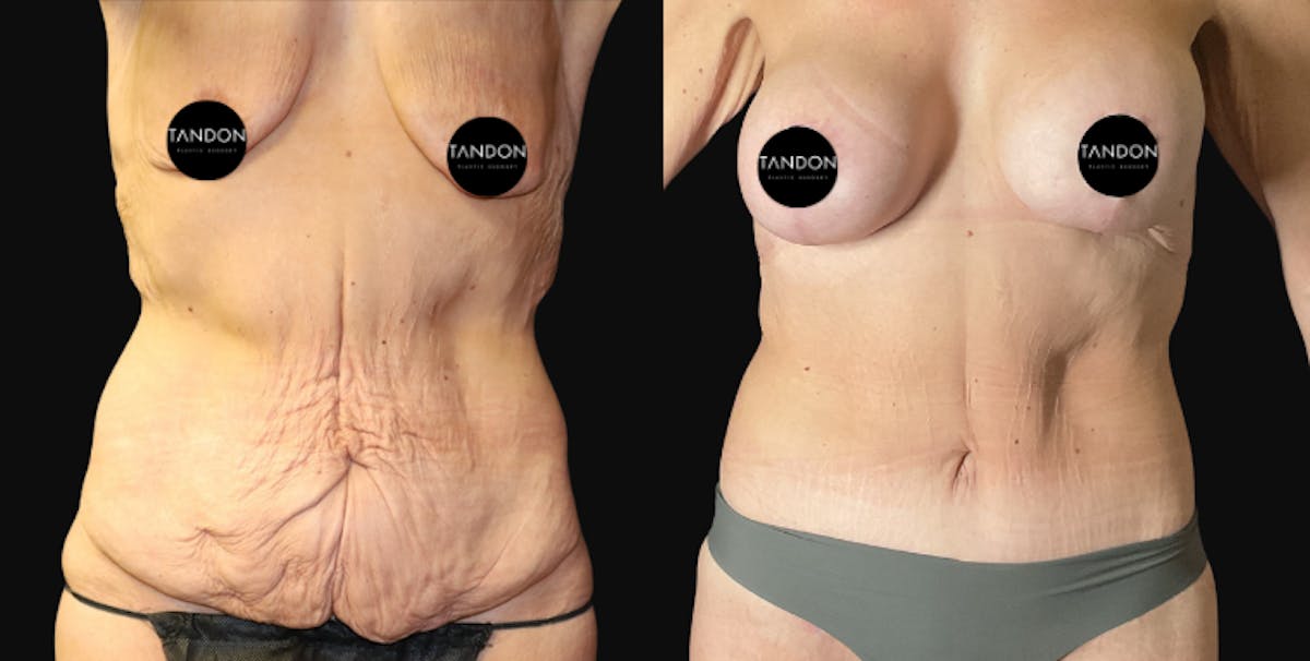 Extreme Weight Loss(LP) Before & After Gallery - Patient 102800 - Image 1