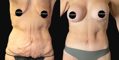 Extreme Weight Loss(LP) Before & After Gallery - Patient 102800 - Image 1