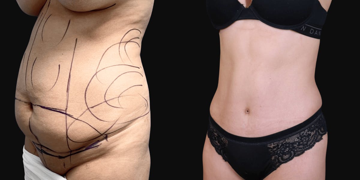 Extreme Weight Loss(LP) Before & After Gallery - Patient 139758 - Image 1