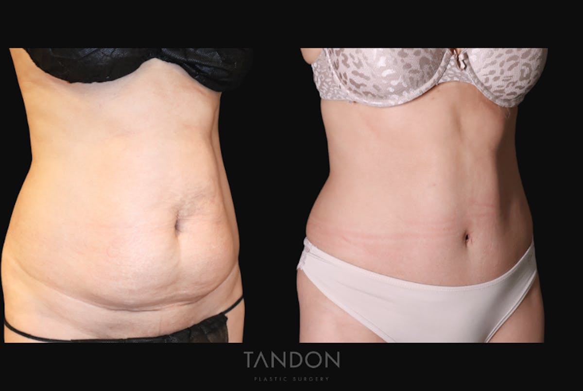 Abdominoplasty (Tummy Tuck) Before & After Gallery - Patient 266028 - Image 2