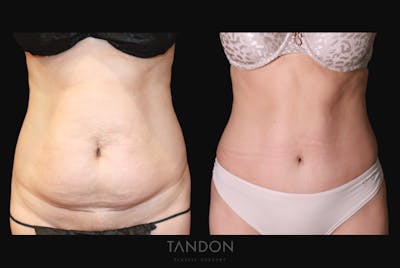 Abdominoplasty (Tummy Tuck) Before & After Gallery - Patient 266028 - Image 1
