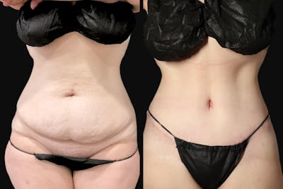 Abdominoplasty (Tummy Tuck) Before & After Gallery - Patient 116498 - Image 1
