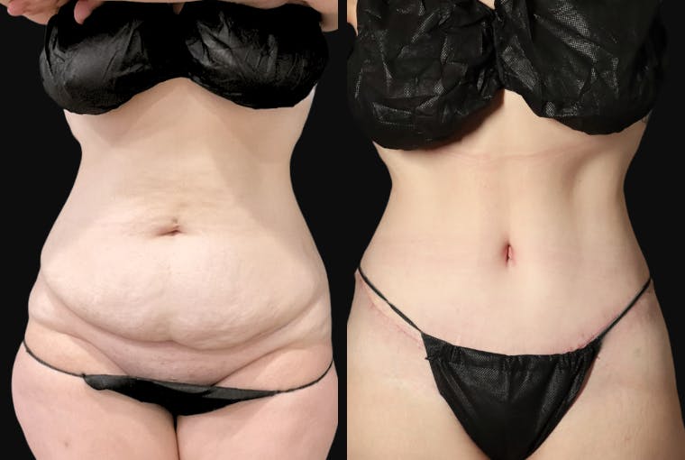 Abdominoplasty (Tummy Tuck) Before & After Gallery - Patient 116498 - Image 1