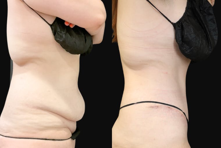 Abdominoplasty (Tummy Tuck) Before & After Gallery - Patient 116498 - Image 3