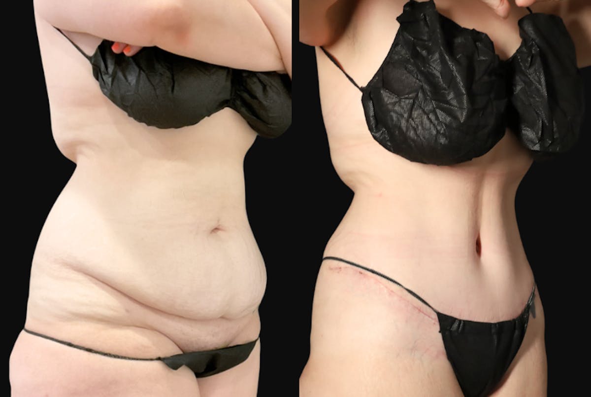 Abdominoplasty (Tummy Tuck) Before & After Gallery - Patient 116498 - Image 2