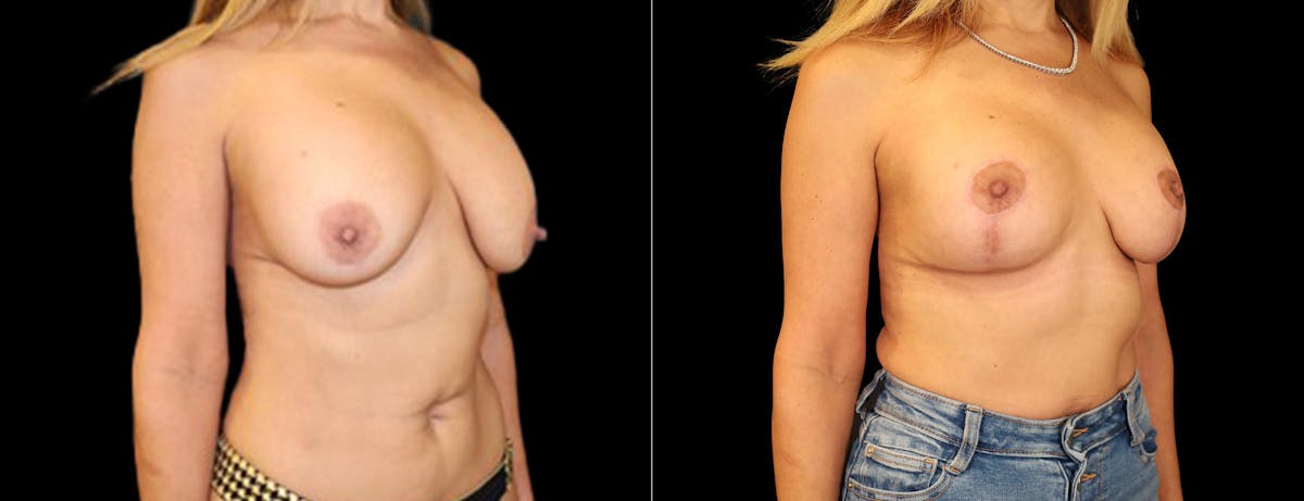 Breast Augmentation Before & After Gallery - Patient 548415 - Image 2