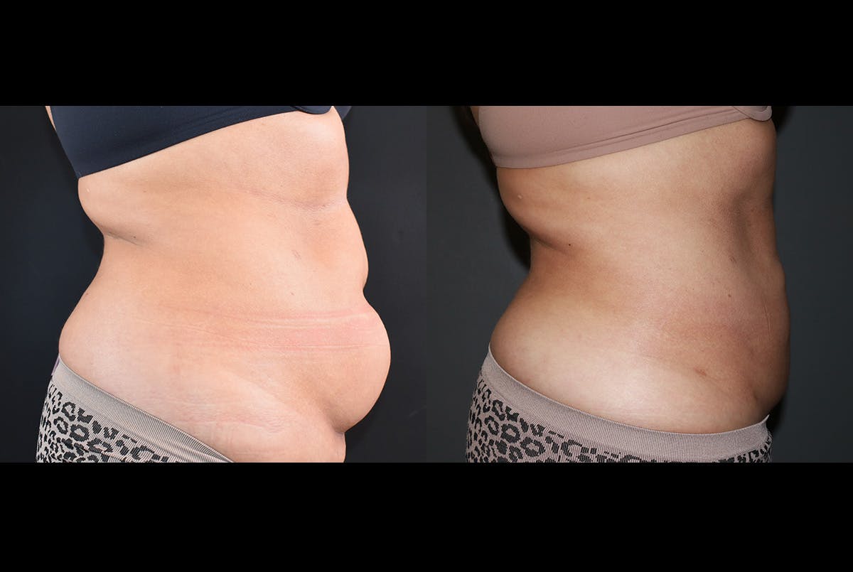 Abdominoplasty (Tummy Tuck) Before & After Gallery - Patient 257848 - Image 2