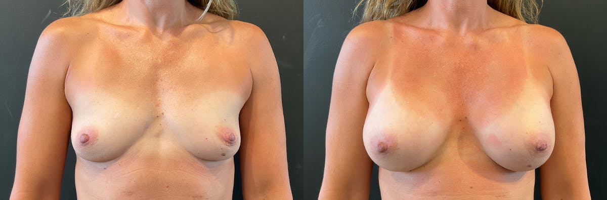 Breast Augmentation Before & After Gallery - Patient 391005 - Image 1
