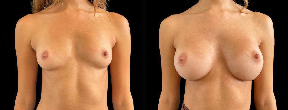 Breast Augmentation Before & After Gallery - Patient 537019 - Image 1