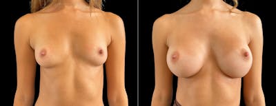 Breast Augmentation Before & After Gallery - Patient 537019 - Image 1