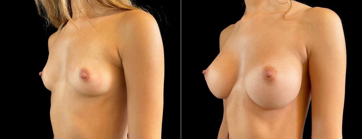 Breast Augmentation Before & After Gallery - Patient 537019 - Image 2