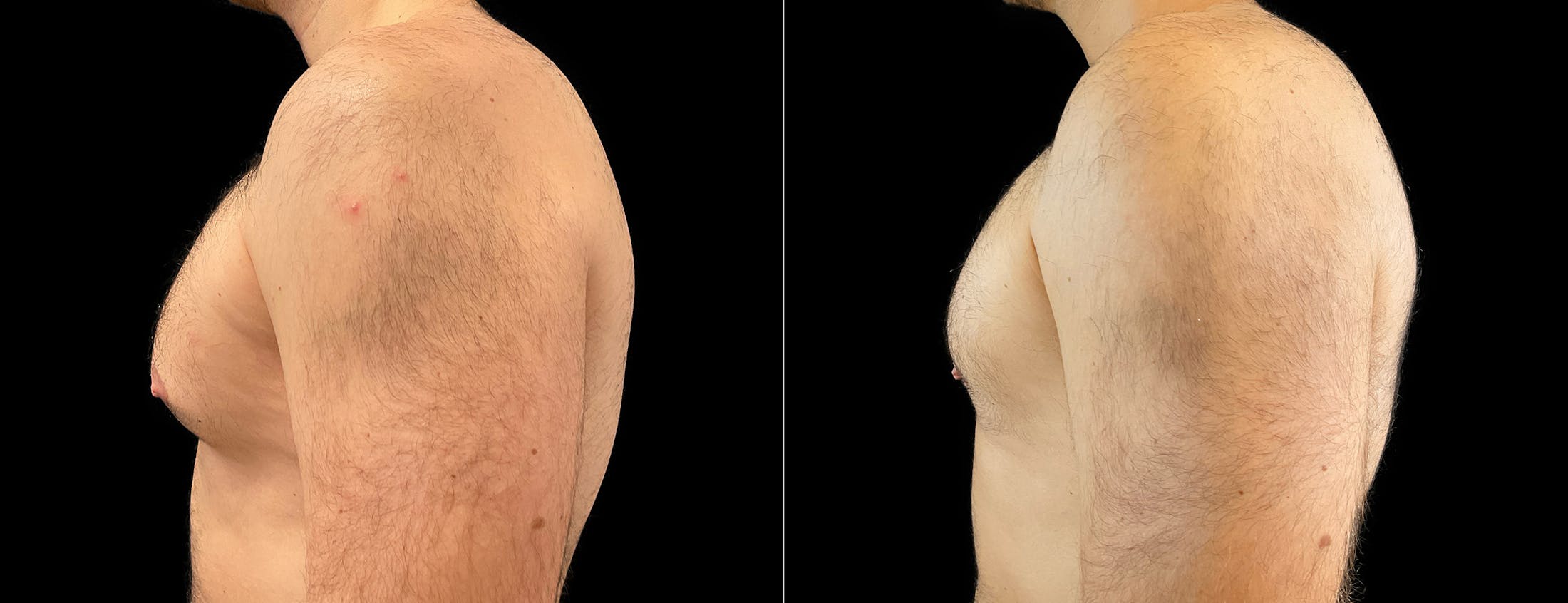 Male Breast Reduction (Gynecomastia) Before & After Gallery - Patient 256590 - Image 2