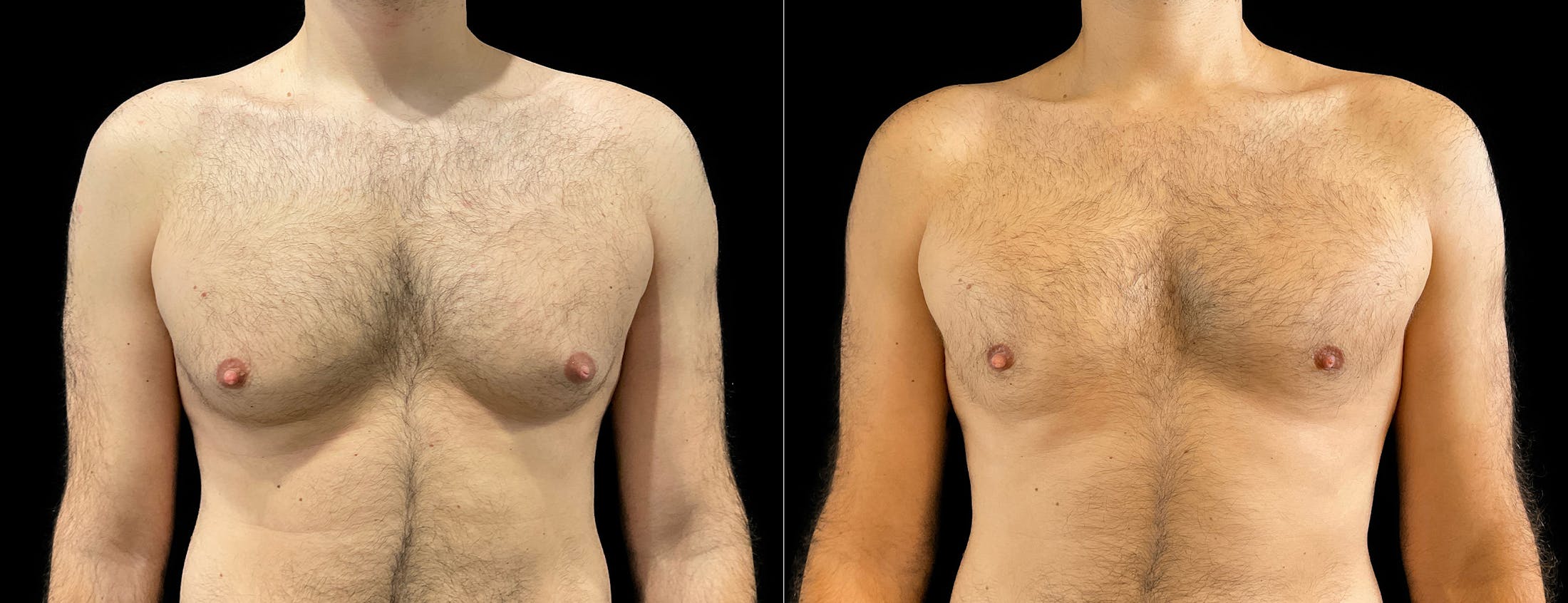 Male Breast Reduction (Gynecomastia) Before & After Gallery - Patient 256590 - Image 1