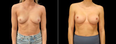 Breast Augmentation Before & After Gallery - Patient 299635 - Image 1