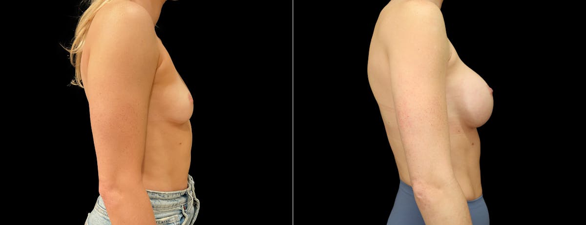 Breast Augmentation Before & After Gallery - Patient 299635 - Image 2