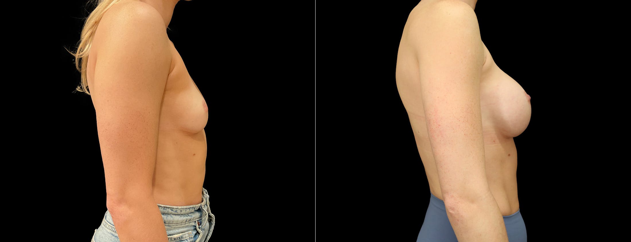 Breast Augmentation Before & After Gallery - Patient 299635 - Image 2