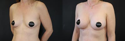 Breast Augmentation Before & After Gallery - Patient 330997 - Image 1