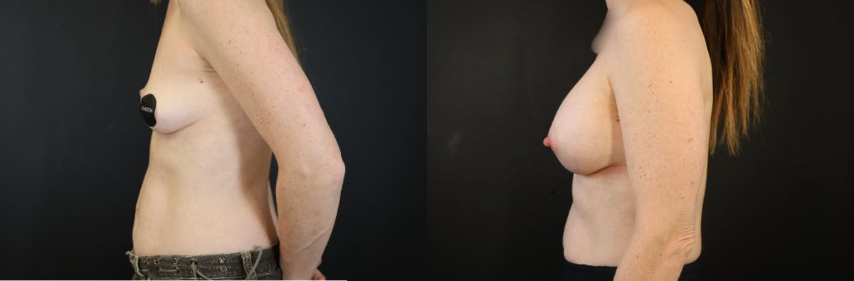 Breast Augmentation Before & After Gallery - Patient 428524 - Image 2