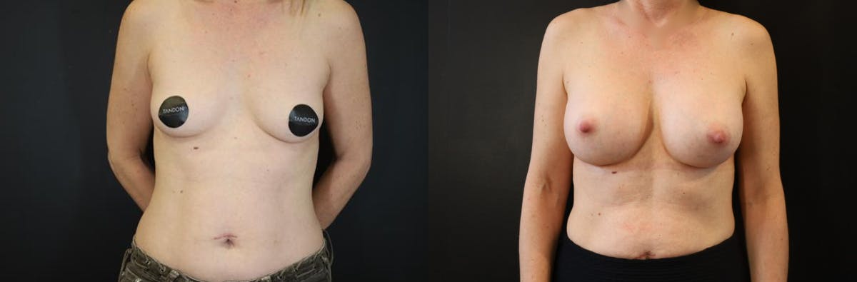 Breast Augmentation Before & After Gallery - Patient 428524 - Image 1