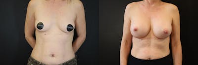 Breast Augmentation Before & After Gallery - Patient 428524 - Image 1
