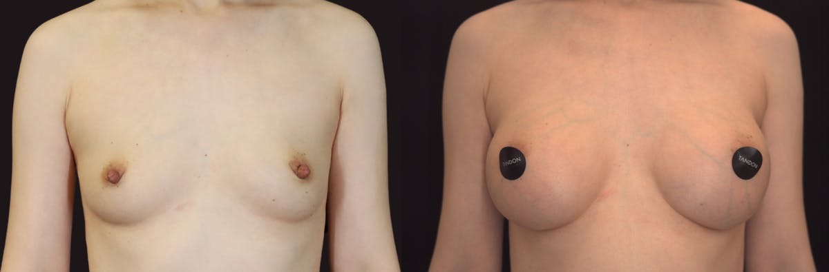 Breast Augmentation Before & After Gallery - Patient 928334 - Image 1