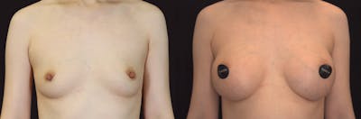 Breast Augmentation Before & After Gallery - Patient 928334 - Image 1