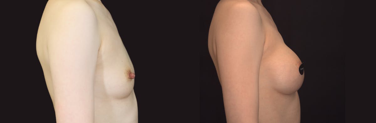 Breast Augmentation Before & After Gallery - Patient 928334 - Image 2