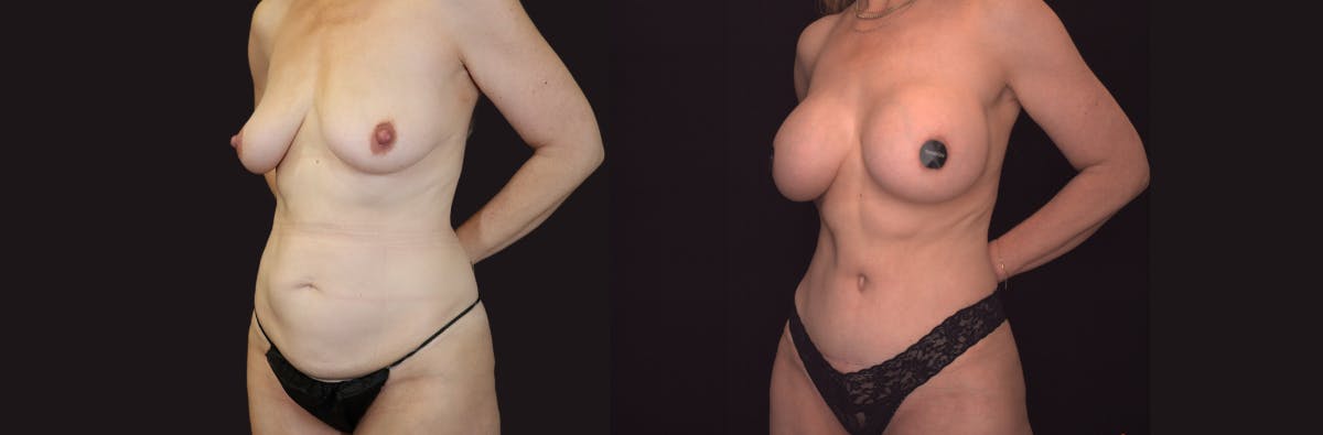 Mommy Makeover Before & After Gallery - Patient 294077 - Image 3